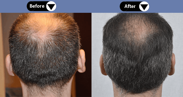 Low-Level Laser Therapy (LLLT) in Derby