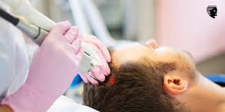 Hair Loss Studio Derby Consultation